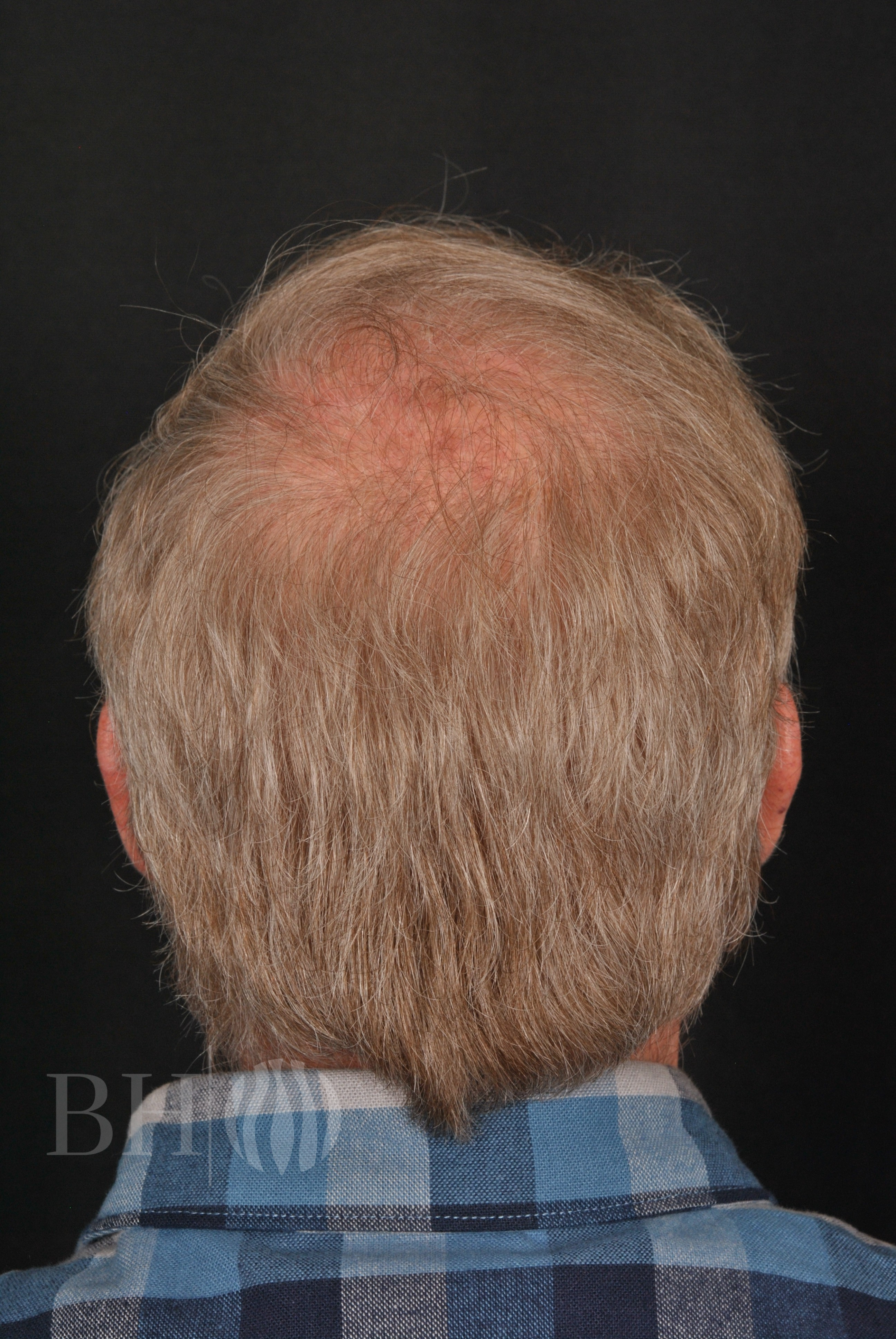 Neograft hair Before and After